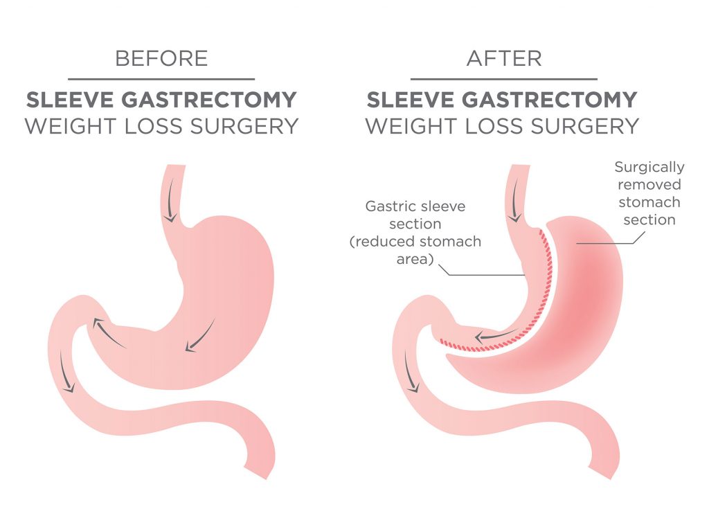 Sleeve Gastrectomy Diagram